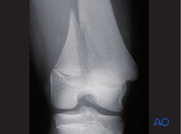 principles of nonoperative treatment of childrens fractures