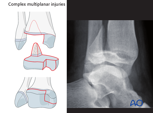 principles of nonoperative treatment of childrens fractures