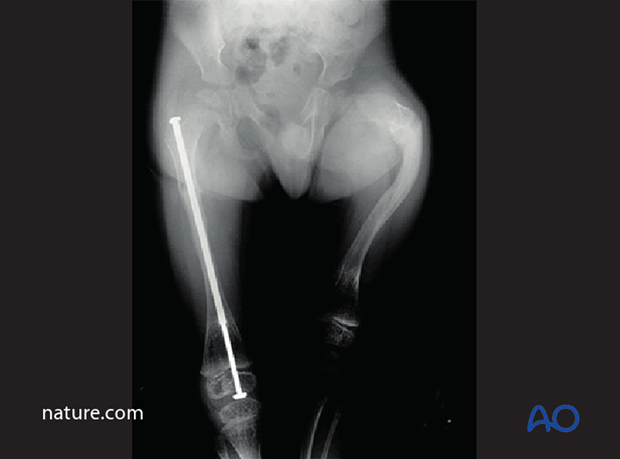 fractures in abnormal bone