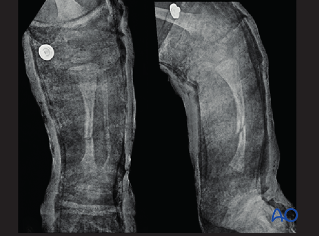 fractures in abnormal bone