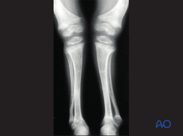 fractures in abnormal bone