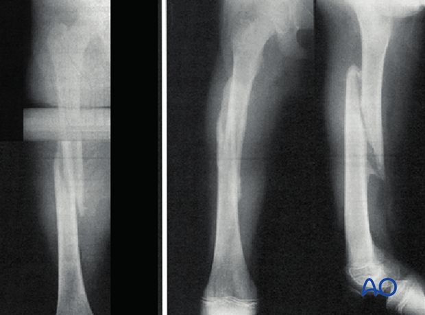 posttraumatic growth disturbance