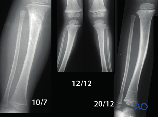 posttraumatic growth disturbance