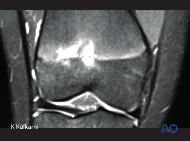 posttraumatic growth disturbance