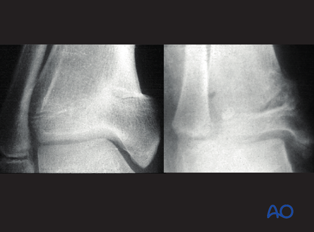 posttraumatic growth disturbance