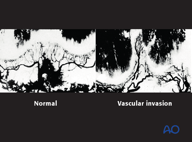 posttraumatic growth disturbance