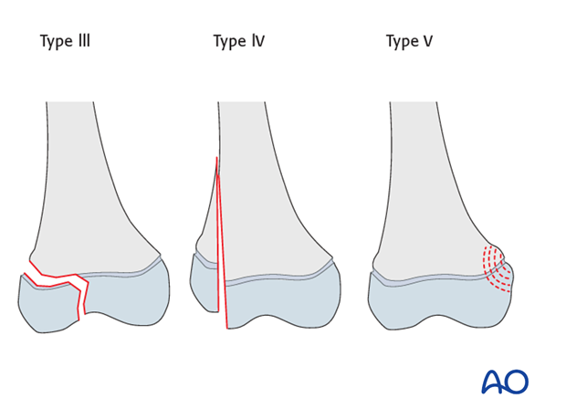 the physis