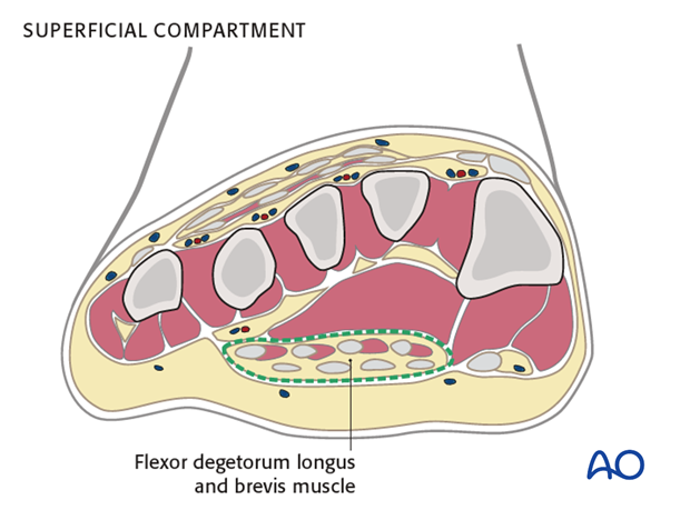 compartment syndrome