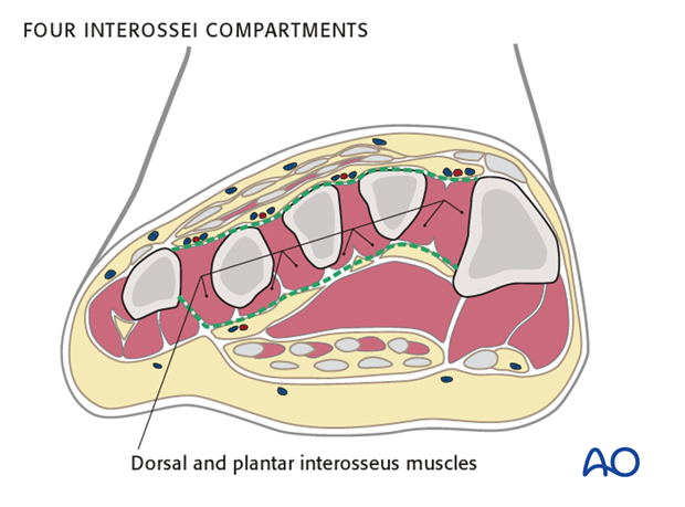 compartment syndrome