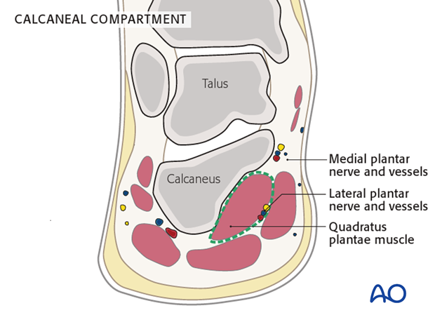 compartment syndrome