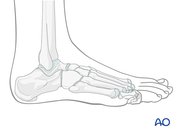 compartment syndrome