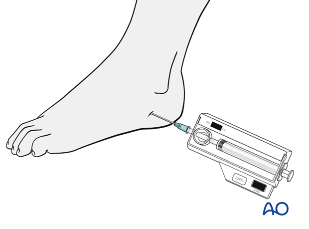 compartment syndrome