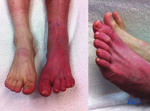 compartment syndrome