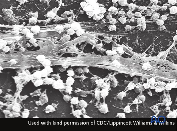 A variety of factors can influence the prognosis of fracture wound infections...