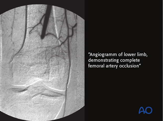 A class BL host has locally compromised soft tissue, or bone.