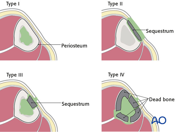 The anatomical classification of osteomyelitis is important for understanding and localizing the infection.