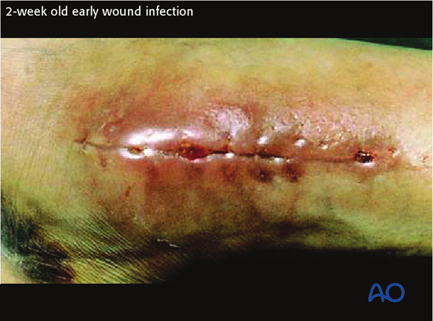 Serial observations of clinical symptoms and signs are most important for identifying the presence of infection.