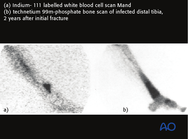 Bone scan