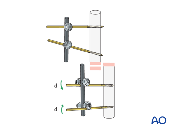 basic technique modular external fixation