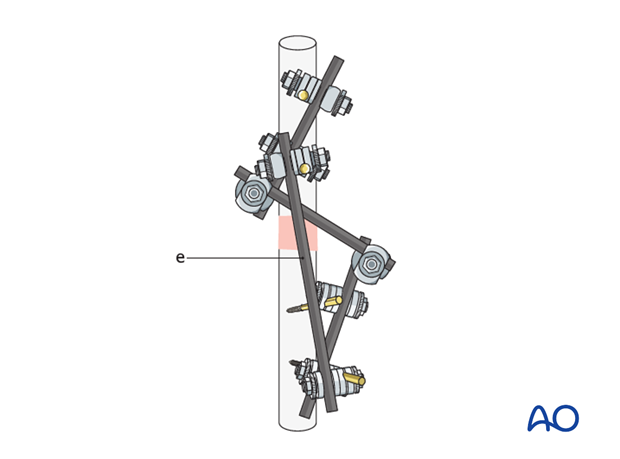 basic technique modular external fixation