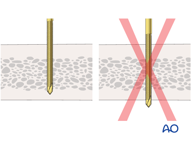 basic technique modular external fixation