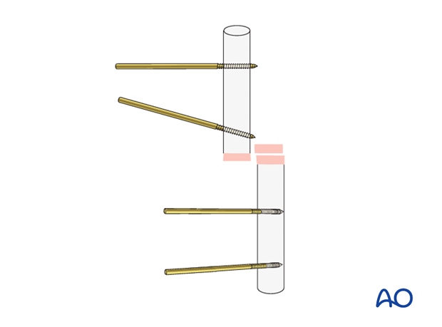 basic technique modular external fixation