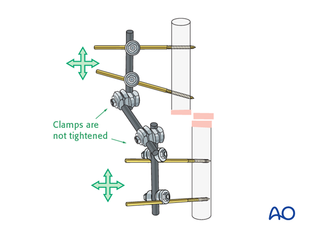 basic technique modular external fixation