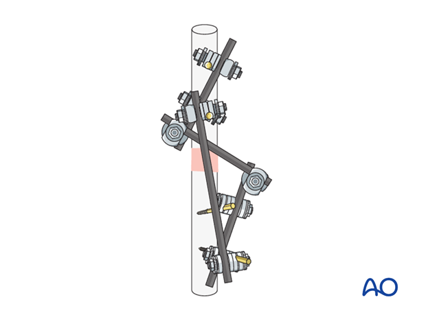 basic technique modular external fixation