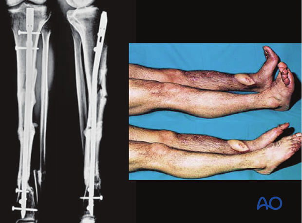 These illustrations show a severe open segmental tibial fracture, in which, short of primary amputation, IMN, using an ...