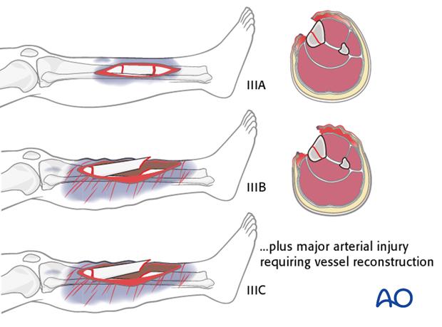 Principles of management of open fractures