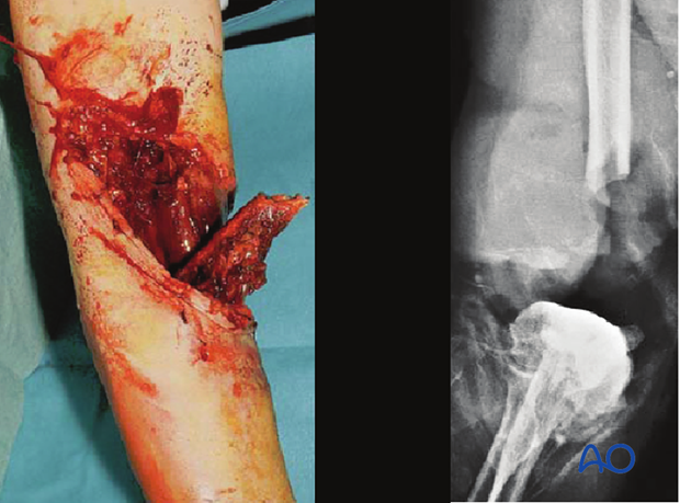 The Gustilo-Mendoza-Williams open-fracture classification separately identifies, as type IIIC, those grade III open fractures...