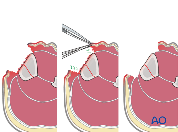 principles of management of open fractures