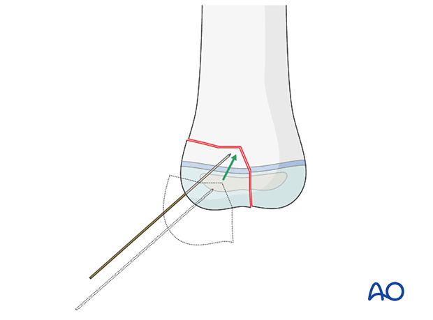 K-wire entry point