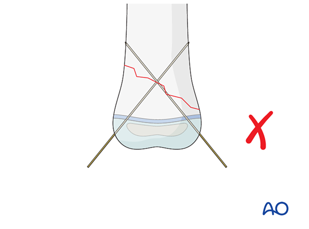 Crossed K-wire fixation with nearly parallel K-wire to oblique fracture plane