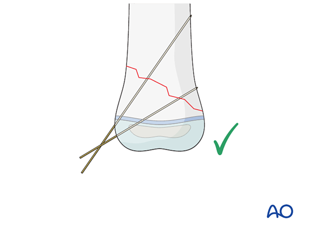 Monolateral divergent K-wires in oblique fractures