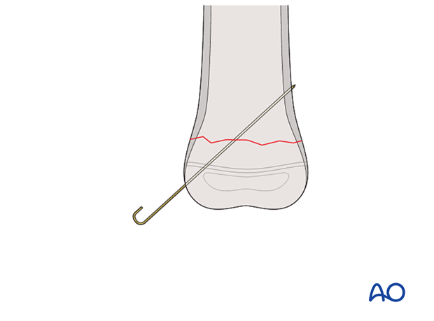 Engaging tip of K-wire in far cortex