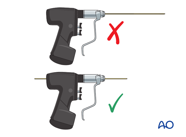 Reduced length of the K-wire protruding from the drill