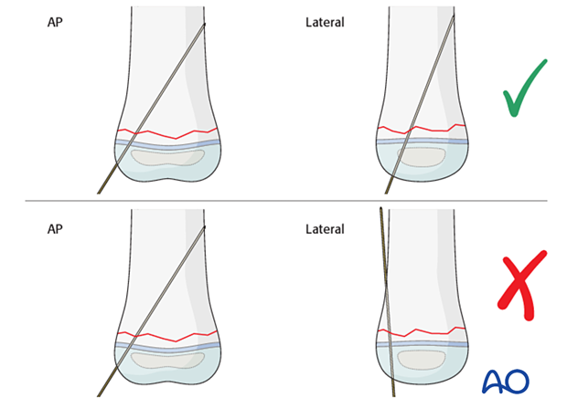 Bony resistance throughout K-wire insertion