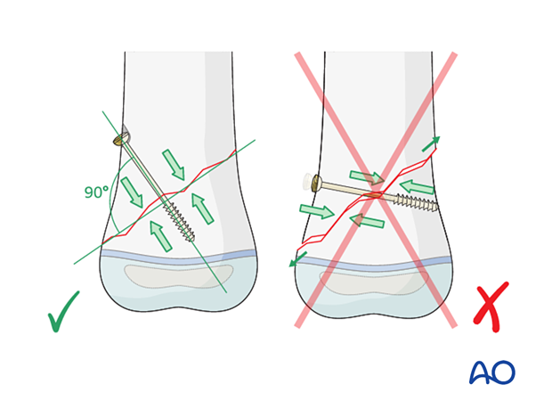 Screws inserted perpendicularly to fracture plane