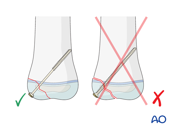 Length of screw thread