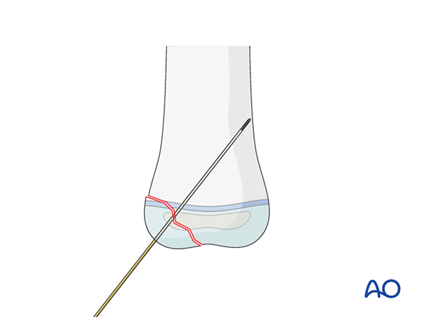 Advancing the guide wire into main fragment