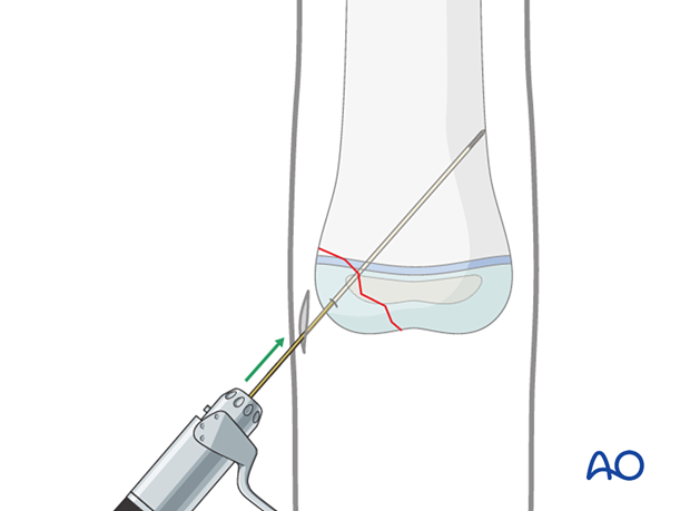 Advancing guide wire into main fragment