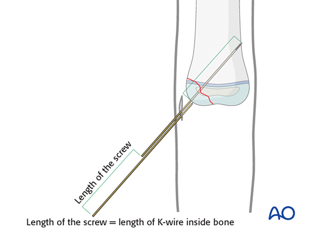 Determining screw length