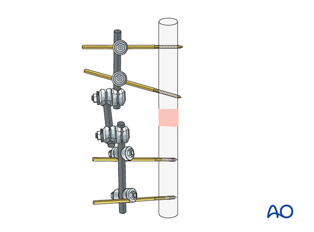 Modular external fixation