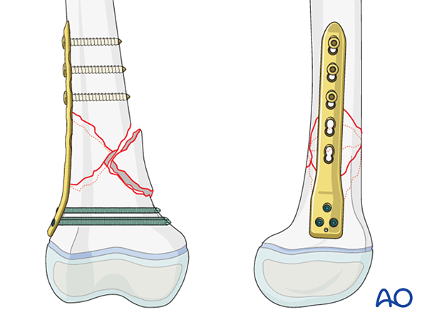 Precontoured plate for fixation of a multifragmentary fracture of the pediatric distal femur