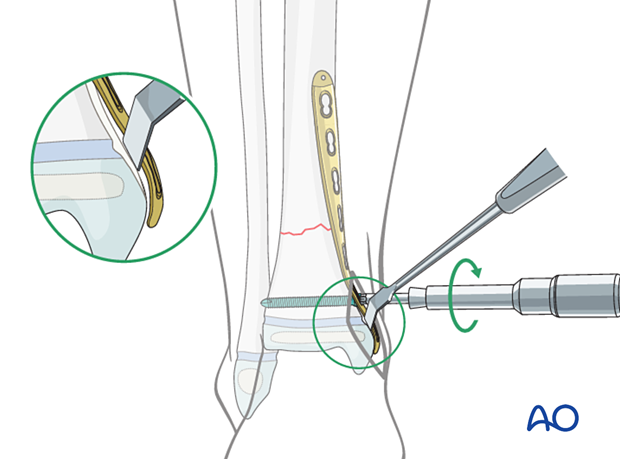 MIPO of a simple fracture of the pediatric distal tibia