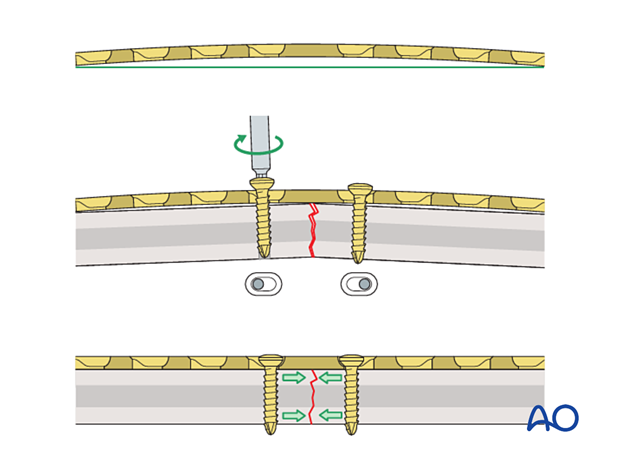 Effect of overbending the plate on the compression across a transverse shaft fracture