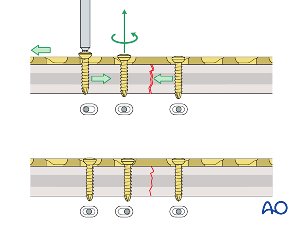 Further compression of a transverse shaft fracture by insertion of the third screw in compression mode