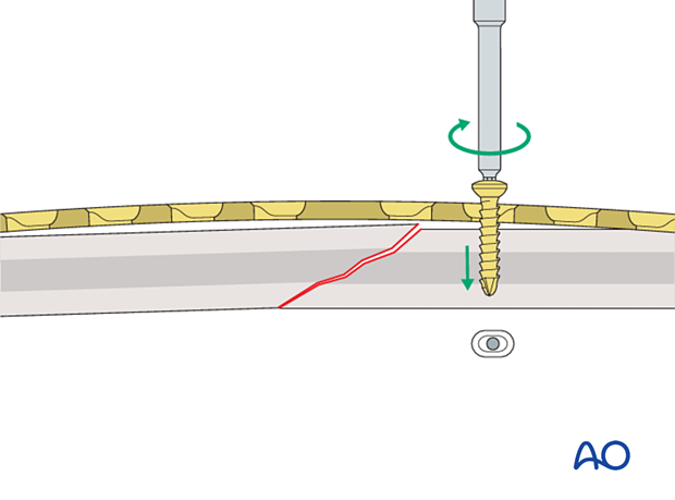 Insertion of the first screw for compression plating of an oblique shaft fracture