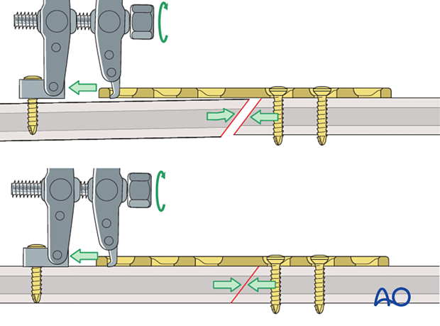 Fracture compression with an articulated tension device in an oblique shaft fracture